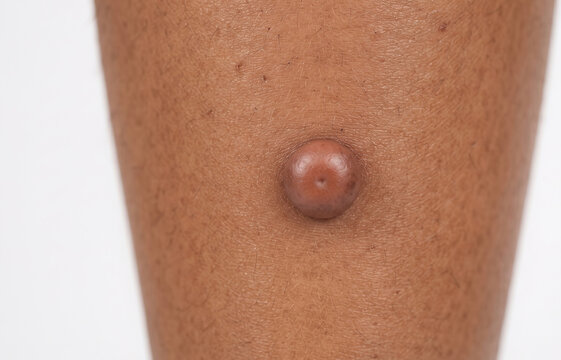 Close up of a raised dermatofibroma skin nodule on dark skin limb