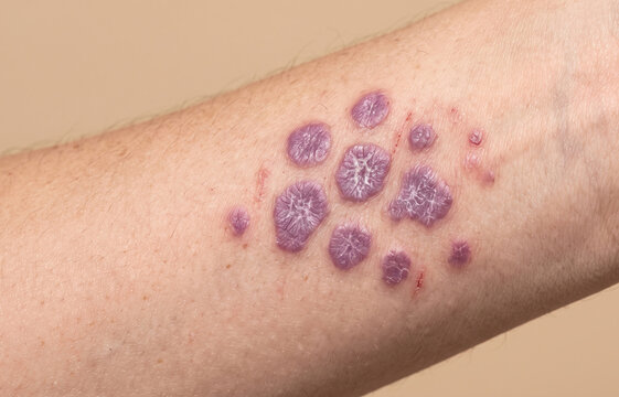 Close up view of purple polygonal papules of lichen planus on forearm skin