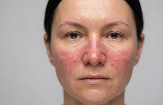 Front portrait of a woman face with severe rosacea redness and inflammatory papules