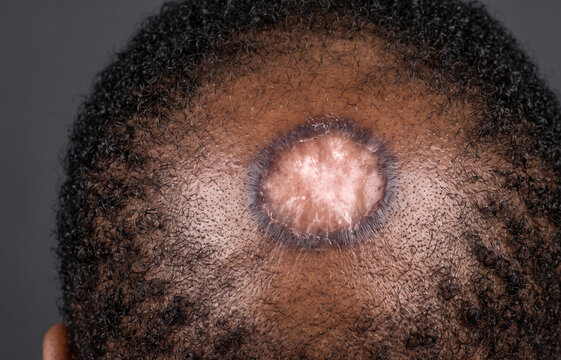 Close up of tinea capitis ringworm fungal infection or alopecia patch on dark skin scalp