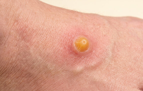 Extreme close up of an infected purulent pustule insect bite or boil on human skin