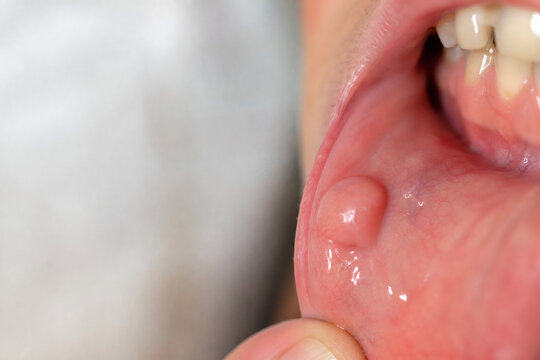 Oral Fibroma as a Smooth Pink Growth on the Buccal Mucosa