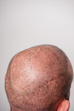head of a young male patient after hair transplant