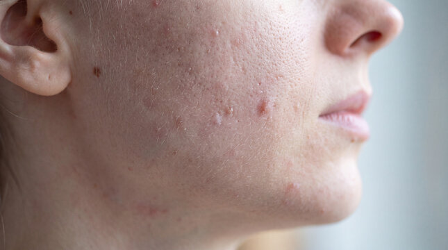 Extreme close-up of a woman's cheek and jawline showing visible acne, pimples, and enlarged pores.