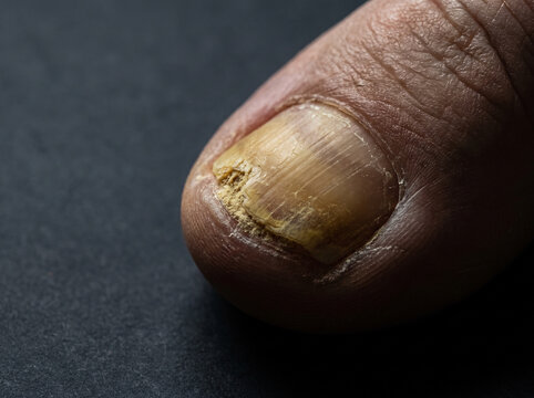Onychomycosis Fungal Nail Infection with Thickened Yellow Crumbling Toenail, Podiatry Macro Medical Reference Photograph