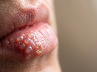 Fototapeta premium Herpes Simplex Cold Sore Cluster of Vesicles on Adult Lip Border, Skin Infection Cropped Macro Medical Photograph