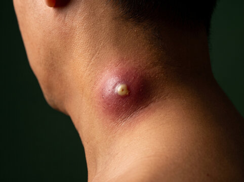 Furuncle Boil Deep Tender Abscess with Central Pustular Head on Adult Neck Skin, Staphylococcal Infection Close Up Photograph