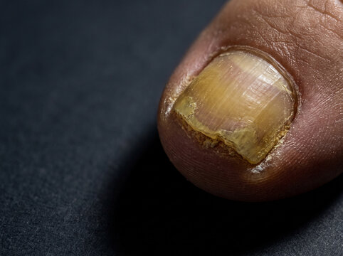 Onychomycosis Fungal Nail Infection with Thickened Yellow Crumbling Toenail, Podiatry Macro Medical Reference Photograph