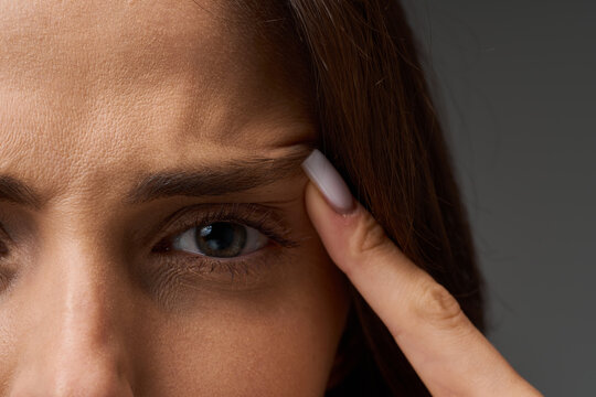 Blepharoplasty and eye lifting assessment. Closeup portrait of a woman pointing her finger at lateral eye corner, demonstrating the potential need for eyelid surgery and brow contour correction