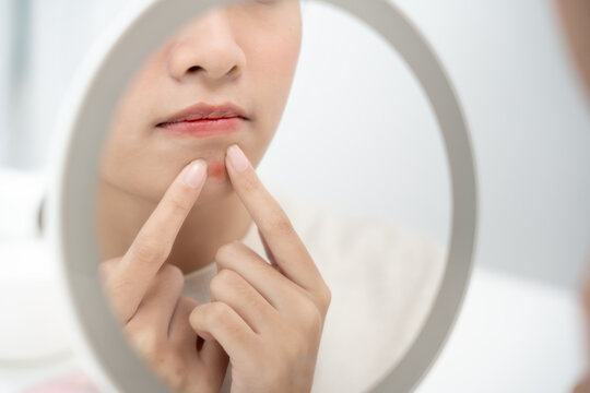 Young woman are worried about faces Dermatology and allergic to steroids in cosmetics. sensitive skin, red face from sunburn, acne, allergic to chemicals, rash on face. skin problems and beauty