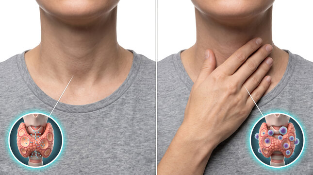 Thyroid gland inflammation and endocrine disorder, medical comparison showing healthy thyroid and abnormal nodules in neck anatomy