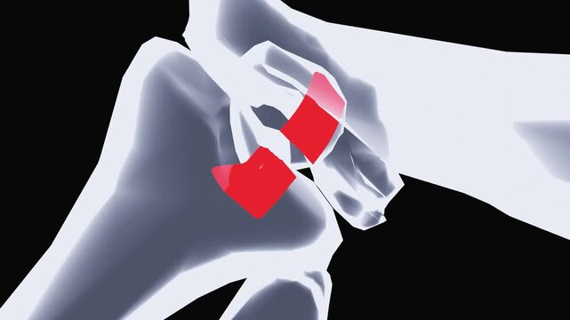 ACL Tear Knee Injury and Ligament Damage Medical Visualization