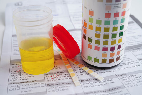Urinalysis, urine cup with reagent strip pH paper test and comparison chart in laboratory.