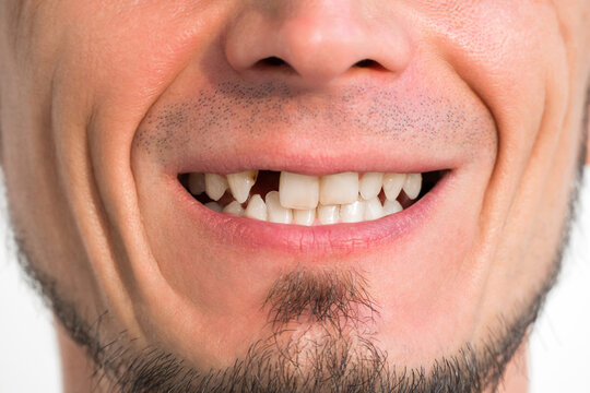 smile with missing tooth close-up. Dental surgery and implantation. Portrait of an adult man with upper front tooth removed on a white background