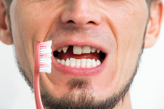 face of a adult man with missing tooth and toothbrush close-up. Dental surgery and implantation. The upper front tooth was removed. Dental problems