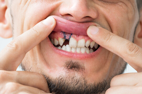 gum suture after bone grafting and dental implant. Dental surgery and implantation. Dental problems in an adult man. Missing removed upper front tooth in male mouth close-up