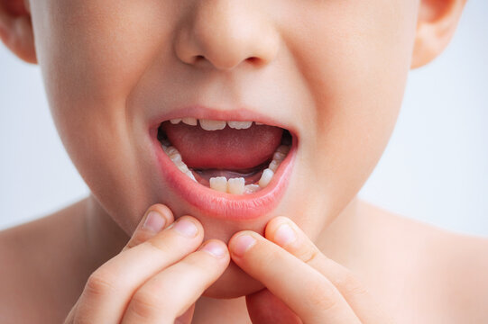 Close-up portrait of child with missing baby tooth, suitable for concepts related to children's healthcare, dental care, oral hygiene, tooth development and pediatric dentistry