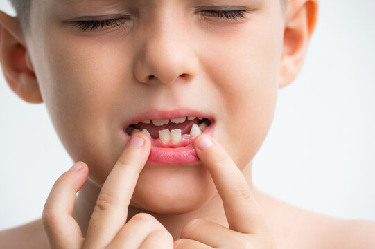 child with lost milk teeth. Replacement of baby teeth with permanent ones. Concept of pediatric dentistry on a white isolated background. Baby's mouth without front lower teeth close-up