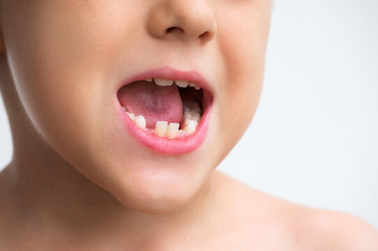 Close-up of a child with a missing tooth, illustrating childhood dental development, oral health, natural tooth loss and growth of permanent teeth