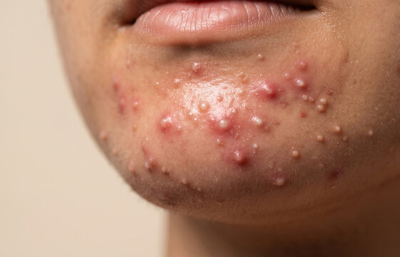 Macro Close Up of Man Chin with Severe Inflammatory Pustular Acne Breakout