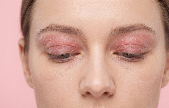 Close Up of Woman Closed Eyes with Severe Eyelid Dermatitis and Red Flaky Skin