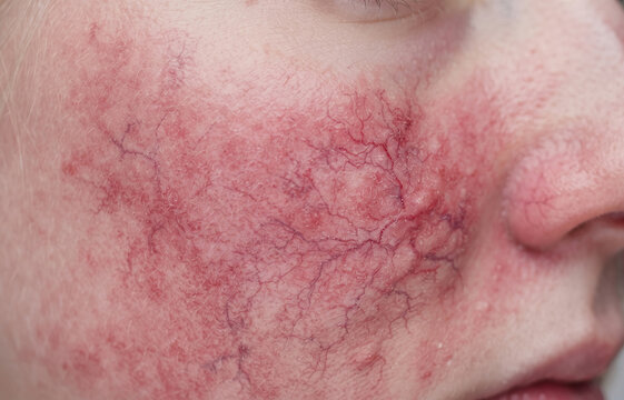 Macro view of spider veins broken capillaries and rosacea on female facial skin