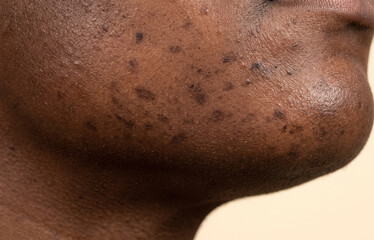 Naklejka premium Close up of post inflammatory hyperpigmentation and acne scars on dark skin jawline