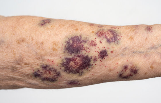 Close up of senile purpura actinic purpura dark bruising and blood spots on elderly arm