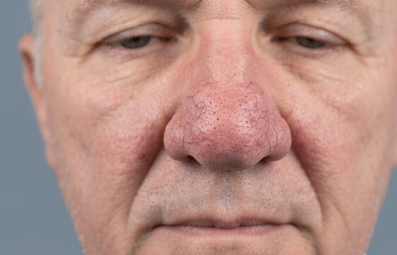 Close up of severe rhinophyma rosacea and broken capillaries on senior male nose