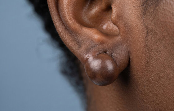 Close up of a large raised keloid scar on African American earlobe