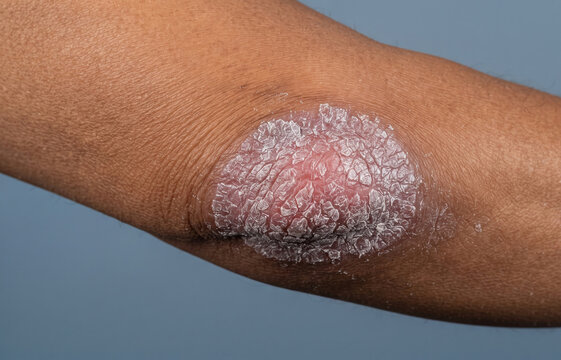Close up of a thick psoriasis scaly plaque on dark skin elbow