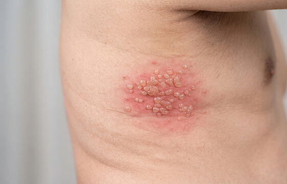 Close up of painful shingles herpes zoster blisters rash on human torso