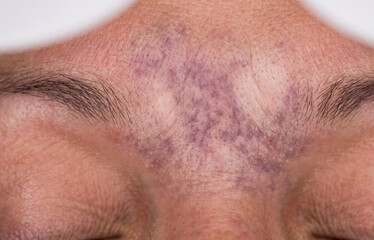 Naklejka premium Close Up Macro View of Facial Telangiectasia Spider Veins and Vascular Lesion on Forehead