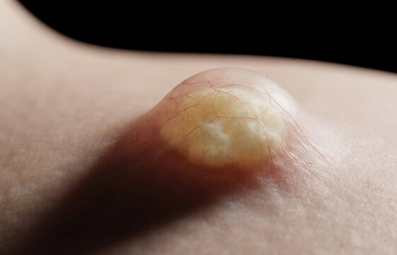 Extreme Macro View of Epidermoid Cyst Purulent Abscess Lump on Human Skin Surface