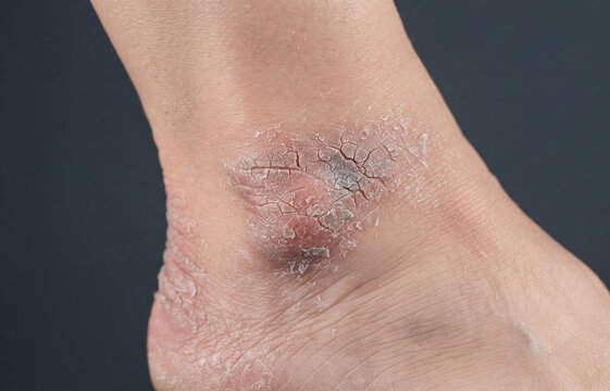 Extreme Close Up of Severely Dry Cracked Skin and Callus on Human Ankle and Heel