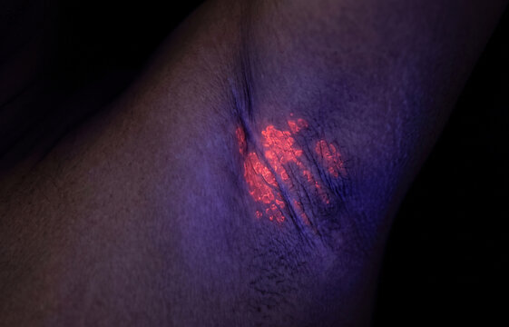 Medical Wood's Lamp UV Light Examination Showing Coral Red Fluorescence of Erythrasma Bacterial Infection