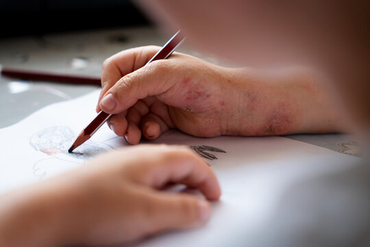 Close Up of Child's Hand With Psoriasis Drawing