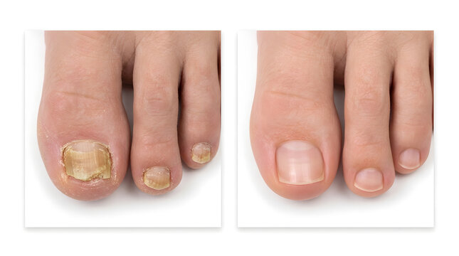 toenail fungus treatment before and after | healthy vs infected toe nails | onychomycosis cure results comparison | fungal nail infection medicine success