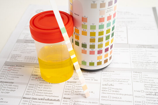 Urinalysis, urine cup with reagent strip pH paper test and comparison chart in laboratory.