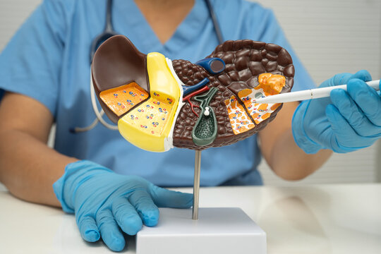 Cirrhosis, Liver cancer, fatty liver, Asian doctor with liver human model.