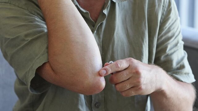 Man using curative topical cream or ointment to affected hand elbow to help from dermatitis, dry patches or psoriasis discomfort. Home skin care medical treatment concept.