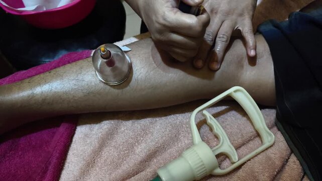 A wide-angle shot of a traditional wet cupping therapy session showing the practitioner using a hand-held vacuum pump on the patient's skin before the lancing process.