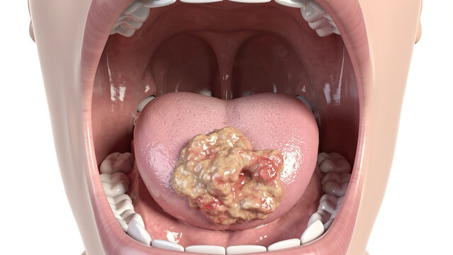 Labeled 3D medical illustration of oropharyngeal cancer, malignant tumor on soft palate in open human mouth, oral‑pharynx anatomical diagram, light grey background