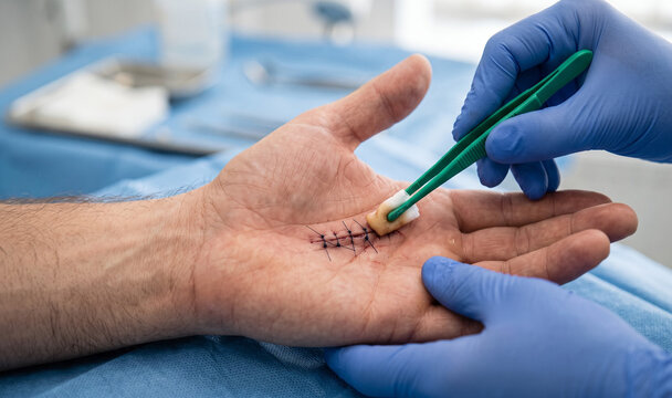 Gloved hands cleaning a sutured wound on a patient's palm with a green swab
