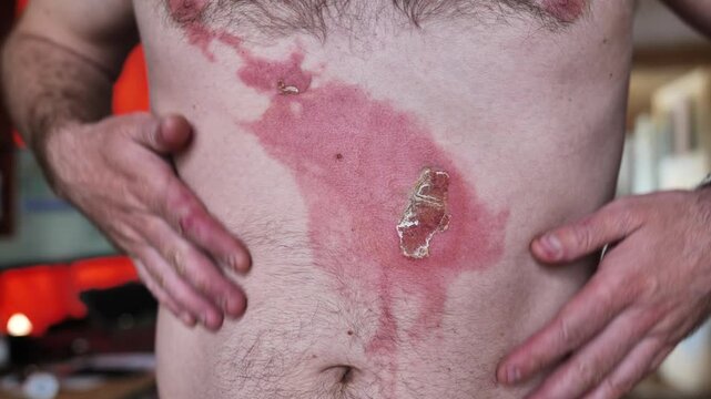 Person experiencing second-degree skin burn on torso, showing redness and blistering