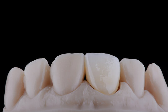 Mirror copy of central maxillary incisor, ultra thin dental ceramic veneer or crown on printed model