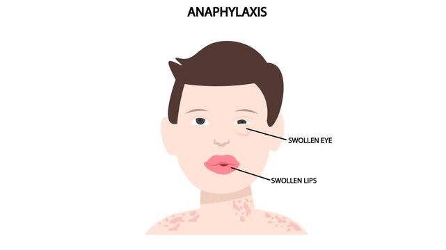 Medical vector animation illustrating anaphylaxis with facial swelling, hives, wheezing, breathing difficulty, and swollen lips, highlighting severe allergic reactions, angioedema, urticaria