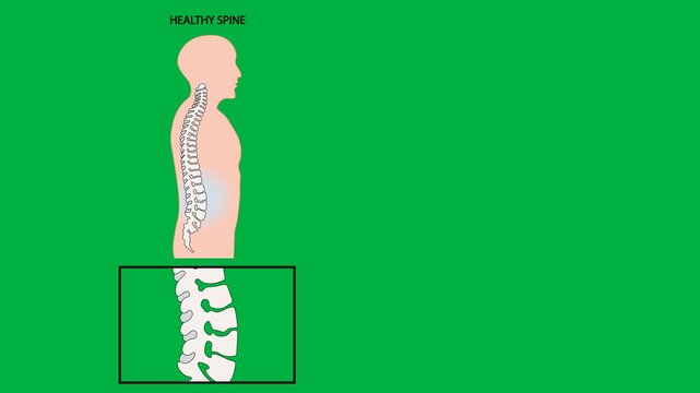 Medical vector illustration showing a healthy spine compared with fused spinal joints in ankylosing spondylitis, highlighting vertebral inflammation, stiffness, structural changes