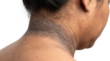 Naklejka premium Rear view of acanthosis nigricans hyperpigmentation on dark skin woman neck back