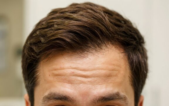 Closeup of a mans forehead and hairline